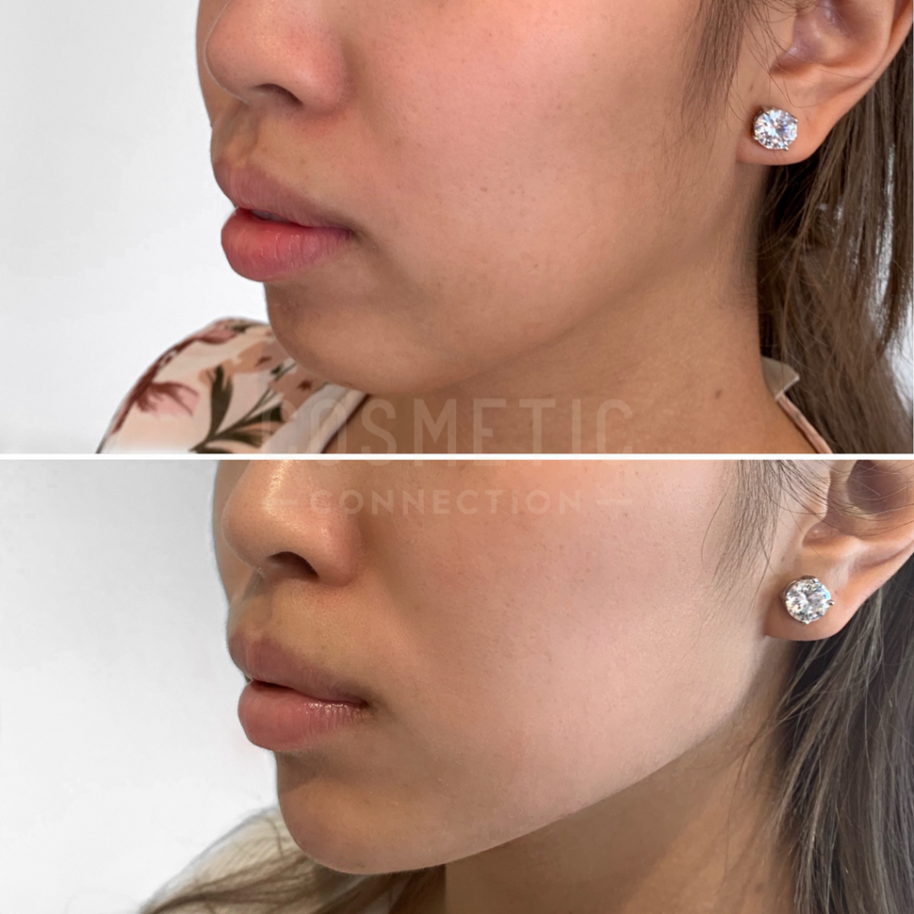 Jawline Sculpting Non Surgical Fillers Cosmetic Connection