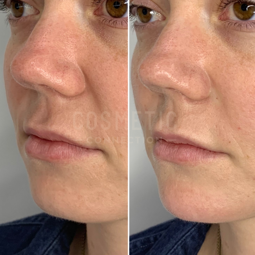 Nasolabial Fold Filler Sydney Cosmetic Connection