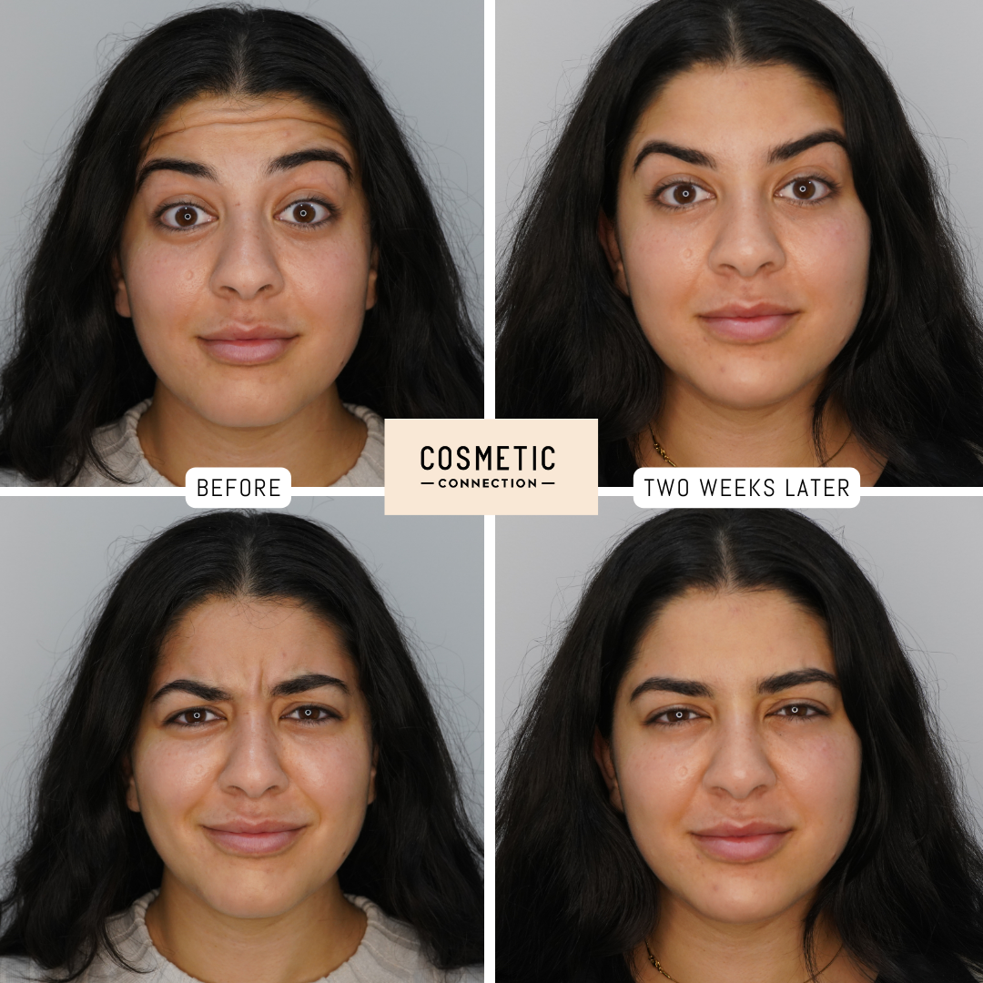https://cosmeticconnection.com.au/wp-content/uploads/2022/07/Anti-wrinkle-Injections-Female-1.png