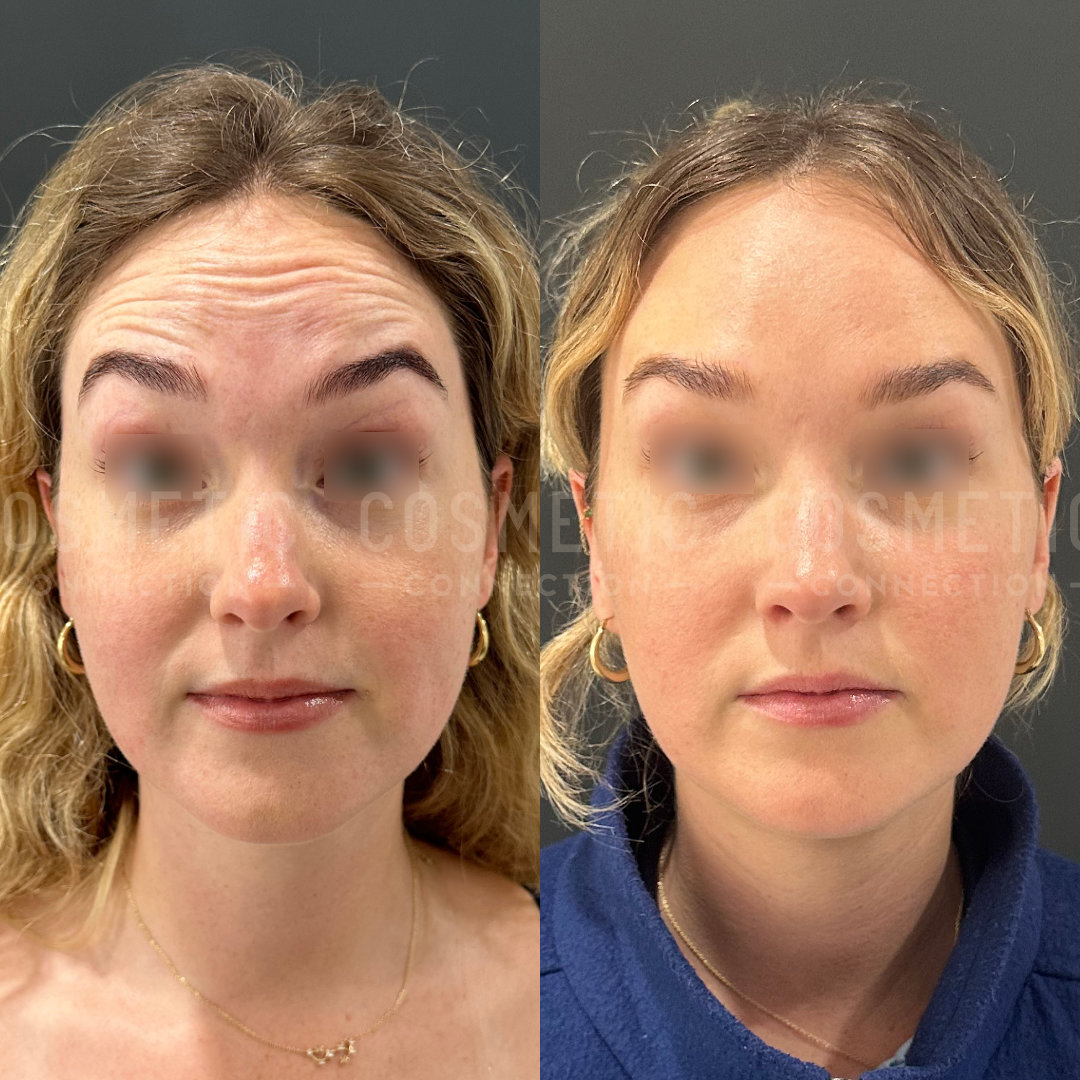 Side-by-side images of a woman before and after a cosmetic procedure. The left image shows noticeable forehead lines, while the right image, taken after the procedure, shows a smoother forehead. Her eyes are obscured for privacy.