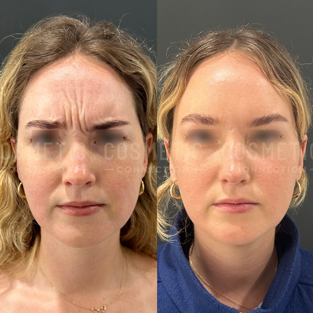 A woman is shown in two side-by-side photos. In the left image, she has a furrowed brow, and in the right image, her expression is relaxed. She has wavy blonde hair and is wearing earrings.