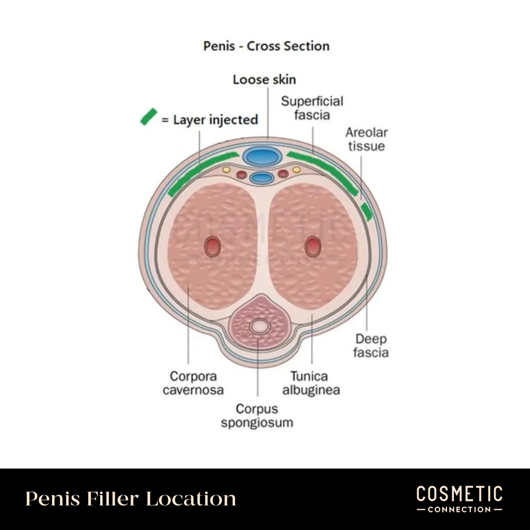 Penis Enlargement with Hyaluronic Acid Fillers