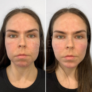 Side-by-side comparison of a woman with long hair wearing a black top, displaying facial changes. The left image shows her face before the changes, while the right shows her face after, with slight differences in skin texture and color.