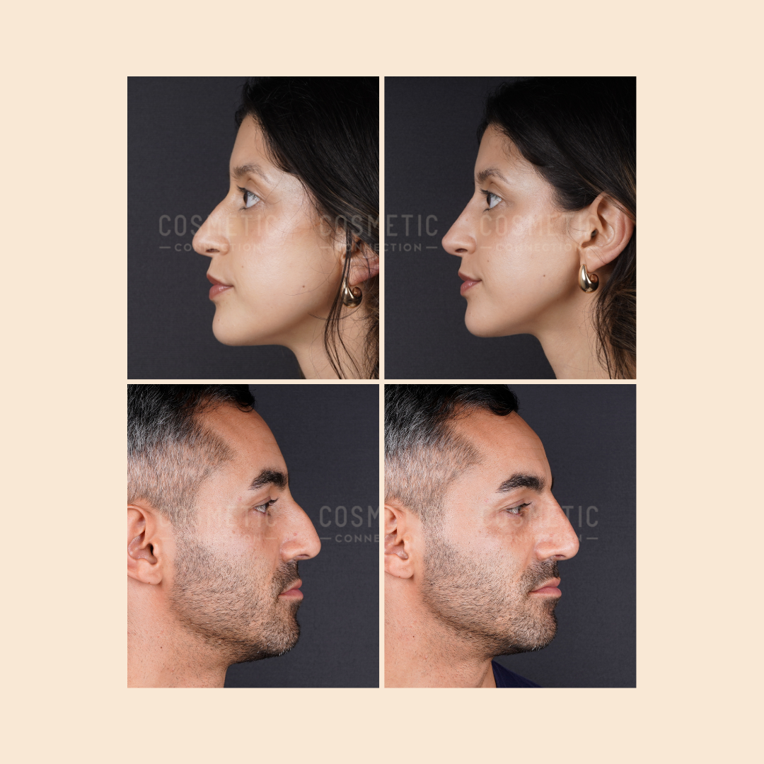 A side-by-side comparison of before-and-after profile photos of a woman (top row) and a man (bottom row) showing changes in their nose and chin areas after cosmetic procedures.