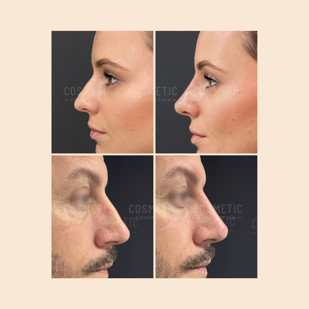 Split-screen images show close-up side profiles of a woman (top row) and a man (bottom row), each pictured before and after a cosmetic nose procedure, highlighting subtle changes in nose shape.