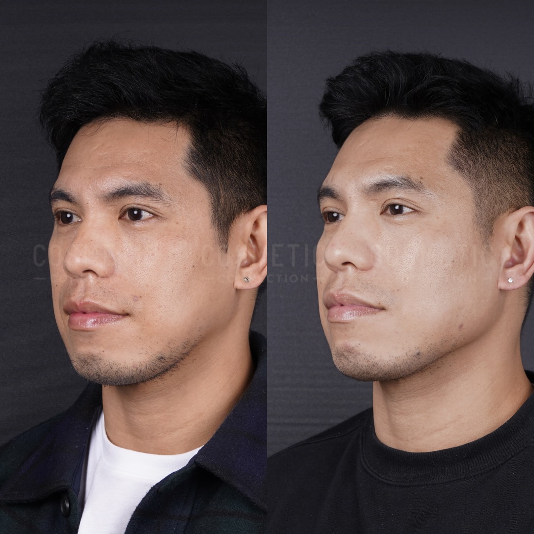 Side-by-side photos of a man before and after a cosmetic procedure, showing differences in his jawline and cheek area. His head is turned slightly to the side in both images, with a neutral expression.