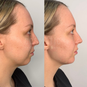 A side-by-side comparison of a womans face before and after dermal fillers to the chin and jawline.