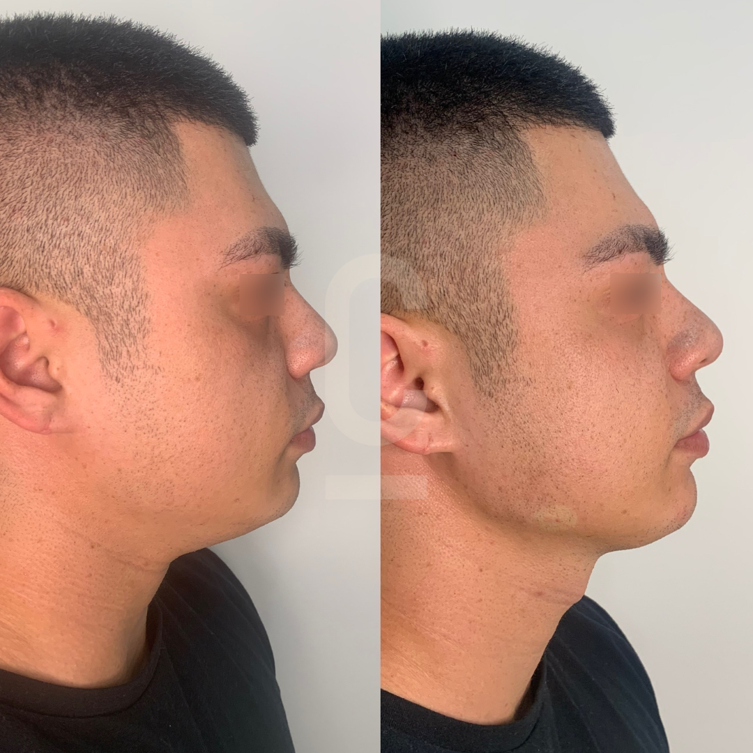 Jawline Sculpting Non Surgical Fillers Cosmetic Connection