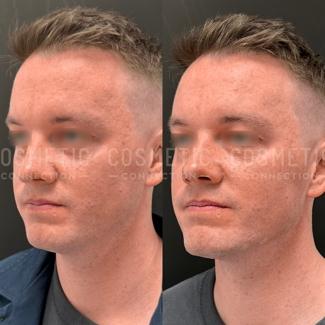 Side-by-side comparison image of a mans face showing before and after cosmetic treatment. The left side displays subtle skin texture and hair differences from the right, highlighting the treatment effects.