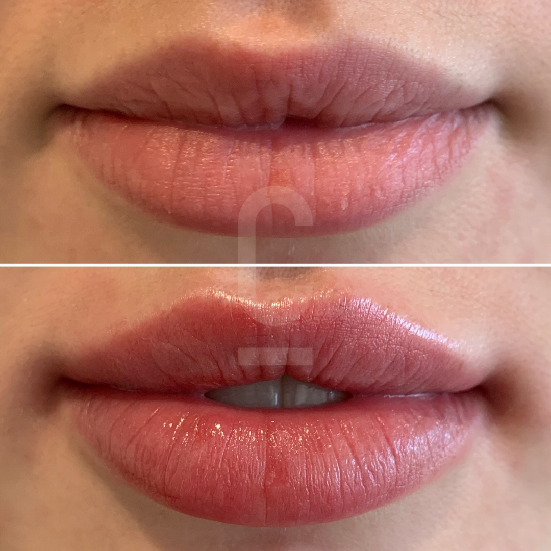 Dermal filler for Cupid's bow - Cosmetic Connection