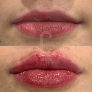 A split image showing a person’s lips before and after lip filler injections; the top shows natural lips, while the bottom displays fuller, glossier lips with enhanced volume and definition.