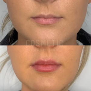 Close-up before-and-after images of a person's lower face highlight fuller and more defined lips in the after photo, resulting from lip filler injections for thin lips.