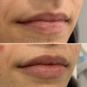 Close-up of a person's lips in two images: the top shows natural lips, while the bottom shows fuller, slightly glossy lips, illustrating the results of lip filler injections or a cosmetic lip treatment.