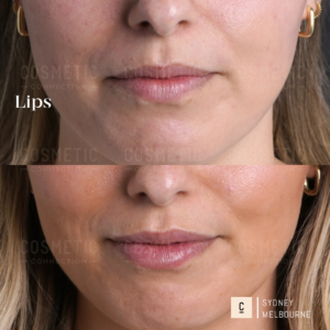 Close-up of a woman's lower face in two images, before and after lip filler injections. Her lips look fuller and more defined in the after image. Text reads Lips and Sydney Melbourne.
