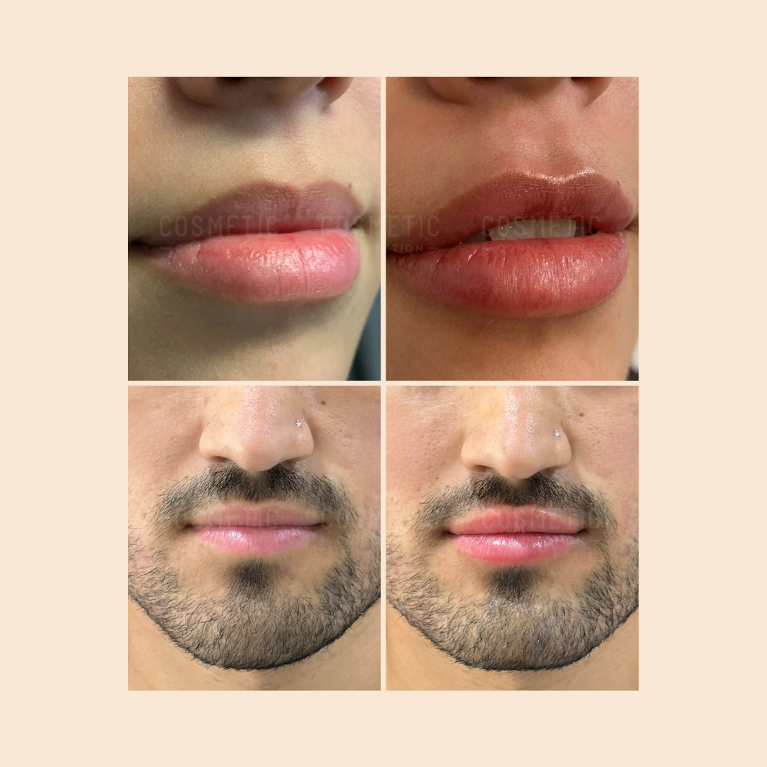 A collage of four close-up images showing two people’s lips and lower faces before and after a cosmetic lip enhancement procedure. The lips appear fuller and more defined in the after photos.