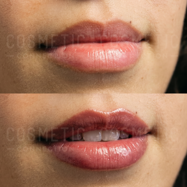Close-up of a person’s lips in two images: the top shows natural lips, while the bottom features fuller, glossy lips, illustrating the effects of lip enhancement or a similar cosmetic treatment.