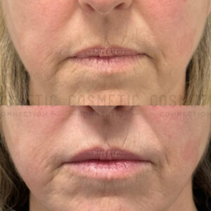 Close-up of a woman’s lower face showing a before and after comparison of lip and lower face skin texture, with visible reduction in wrinkles and smoother skin in the after image following natural lip filler injections.