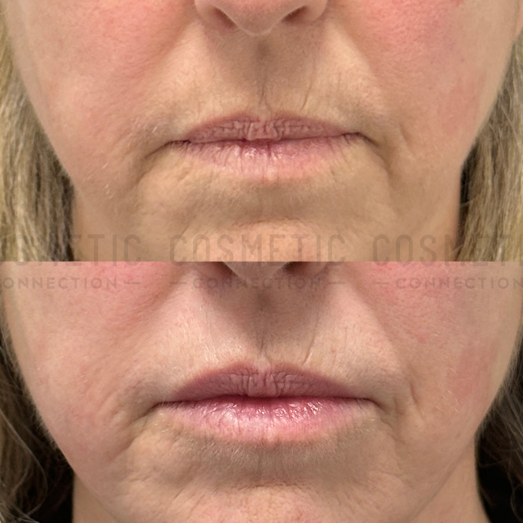 Close-up of the lower face of a person, showing a before and after comparison of the mouth and chin area. The after image shows fuller lips and reduced wrinkles around the mouth.