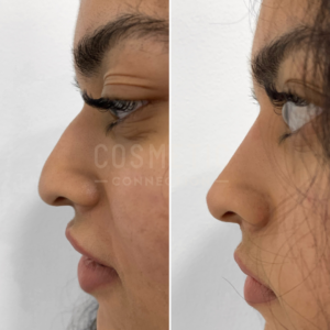 Side-by-side comparison of a persons nose profile before and after non surgical rhinoplasty. The left image shows a more prominent nose and the right image displays a smoother, more refined contour. Both images are from the same angle against a neutral background.