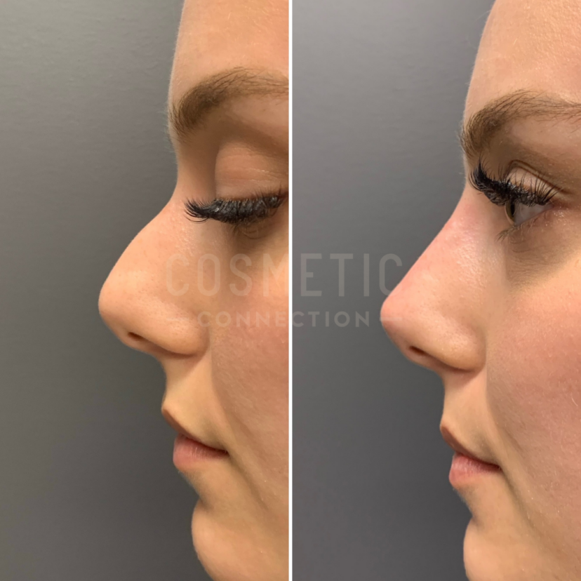 NonSurgical Nose Job Explained Cosmetic Connection