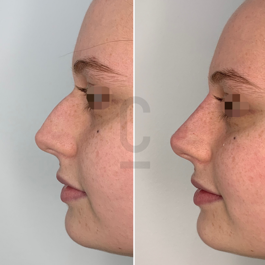 understanding-3-point-rhinoplasty-cosmetic-connection