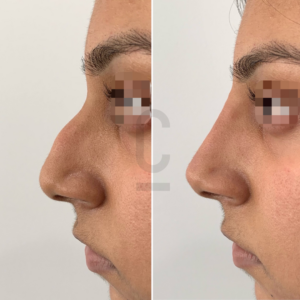 Side-by-side comparison of a persons profile before and after non surgical rhinoplasty. The left shows a pronounced nasal hump, and the right shows a smoother nose profile. Eyes are pixelated for privacy.