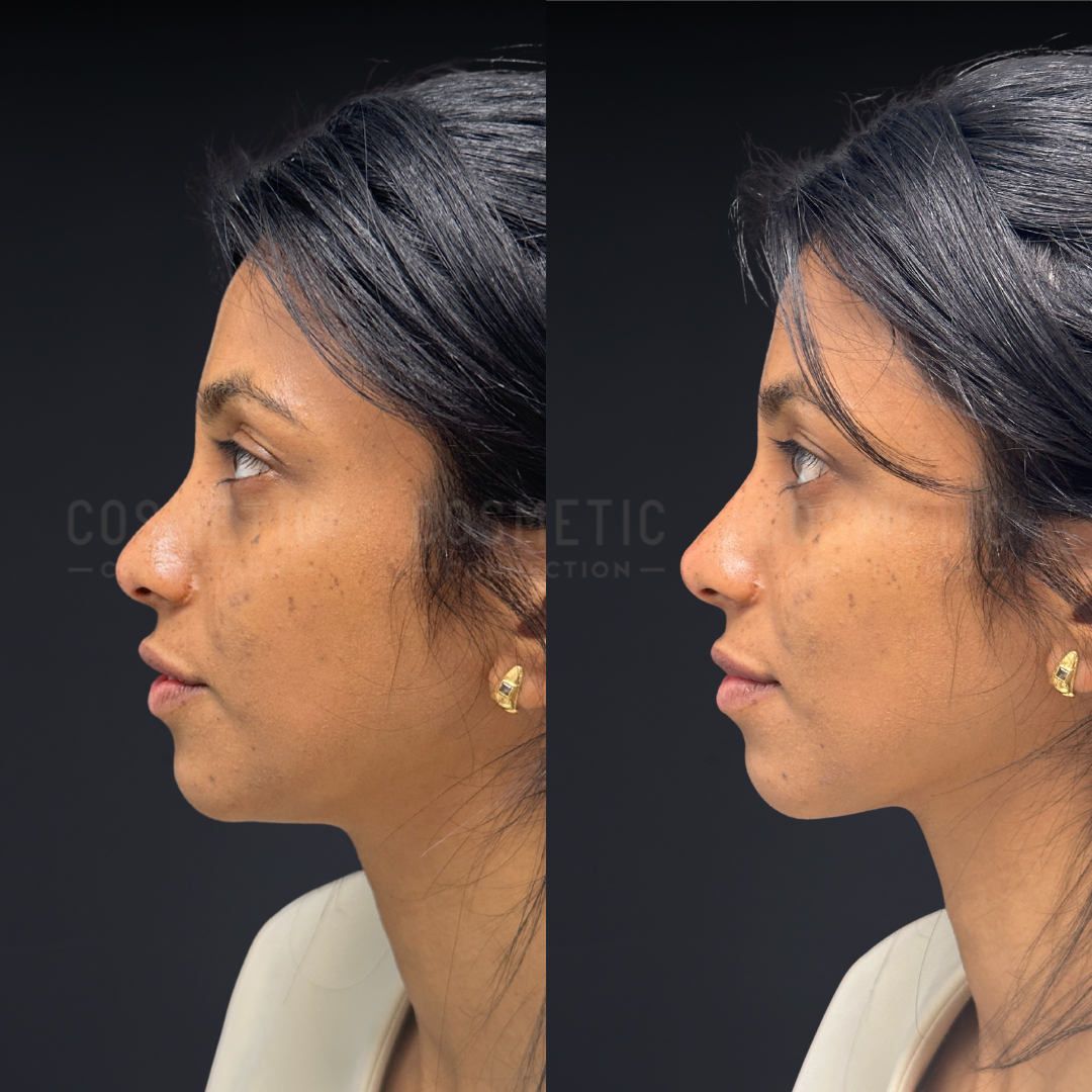 Side-by-side profile photos of a woman before (left) and after (right) a cosmetic procedure, showing changes to her nose and chin. She has dark hair, wears gold earrings, and looks straight ahead.
