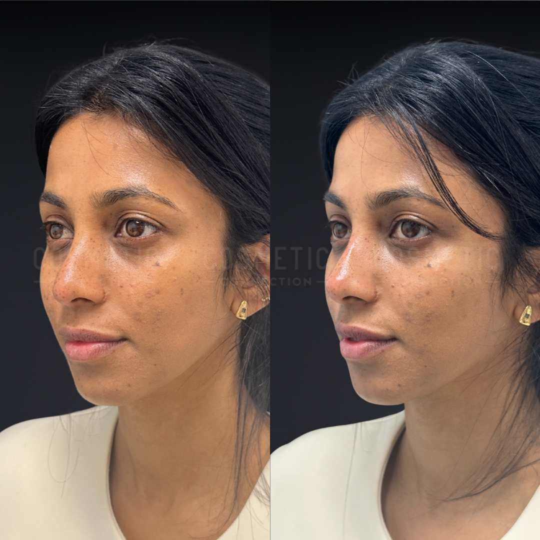 Side-by-side photos of a woman before (left) and after (right) a cosmetic treatment, showing improved skin_texture, fewer dark spots, and a more even, glowing complexion. She wears a cream top and gold earrings.