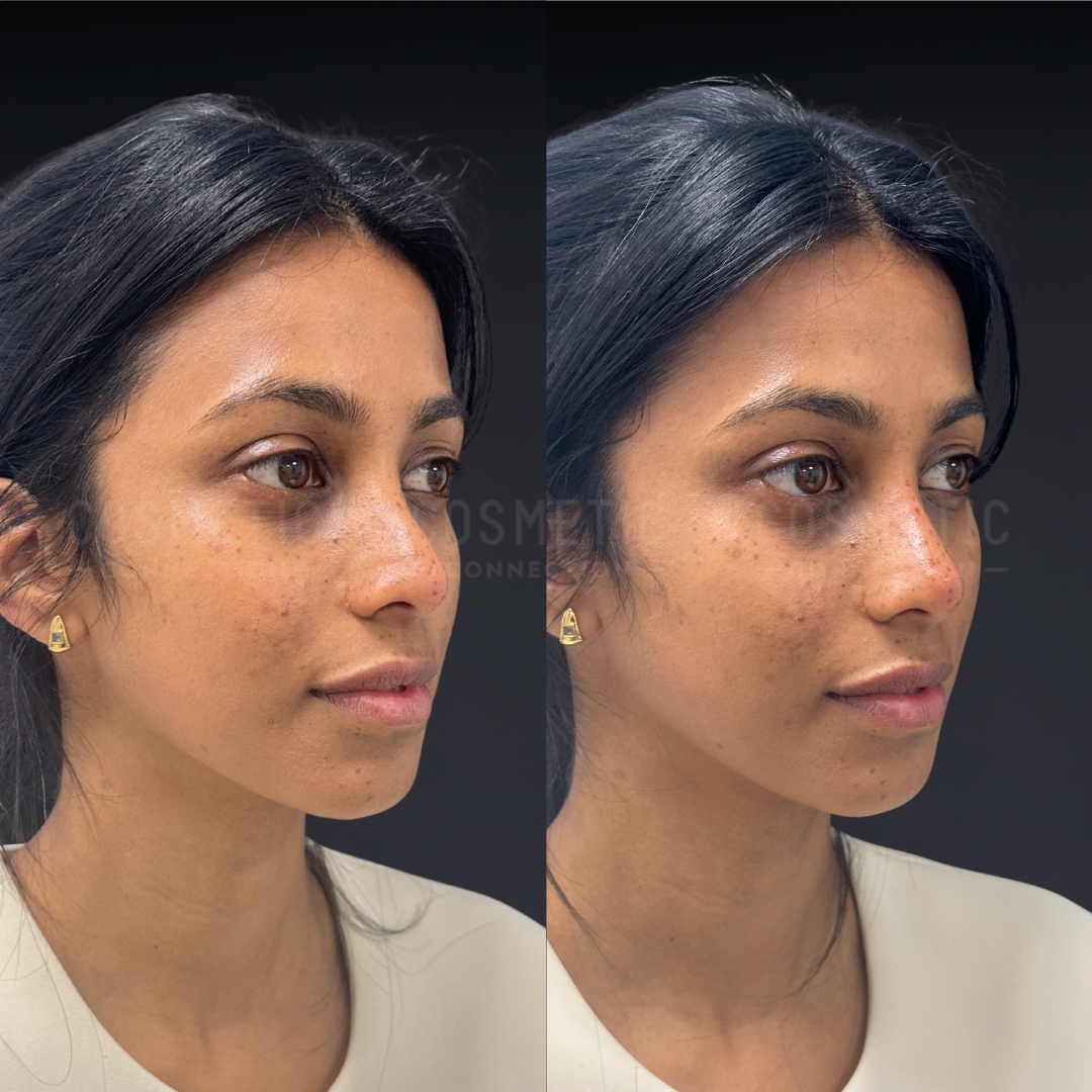 Side-by-side comparison of a woman’s face before (left) and after (right) a cosmetic procedure, showing smoother skin, reduced dark spots, and a more even complexion. She has dark hair and is wearing gold earrings.