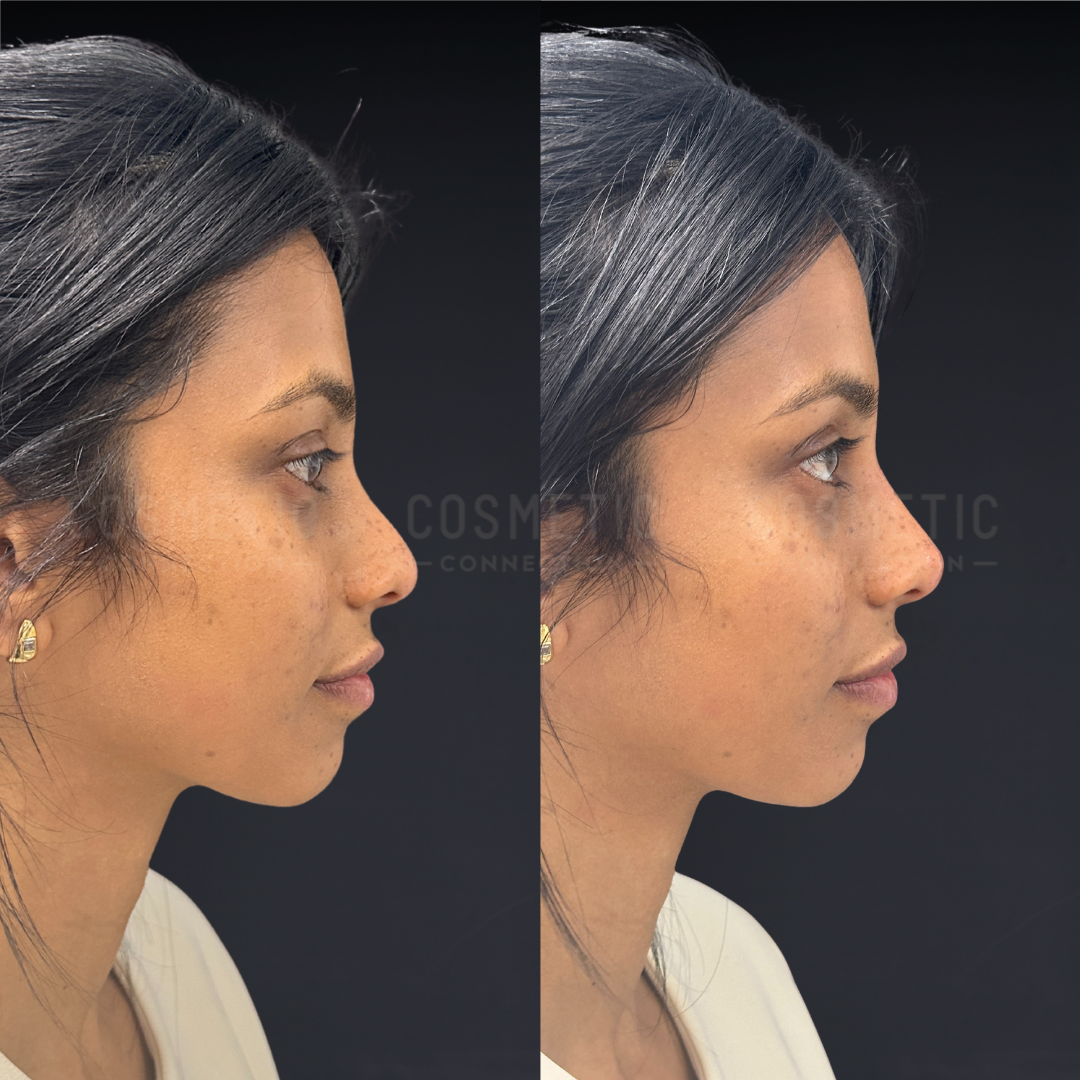 Side-by-side profile photos of a woman with medium-brown skin and dark hair, showing her nose before (left) and after (right) a cosmetic procedure, against a black background. Her nose appears more refined in the after image.