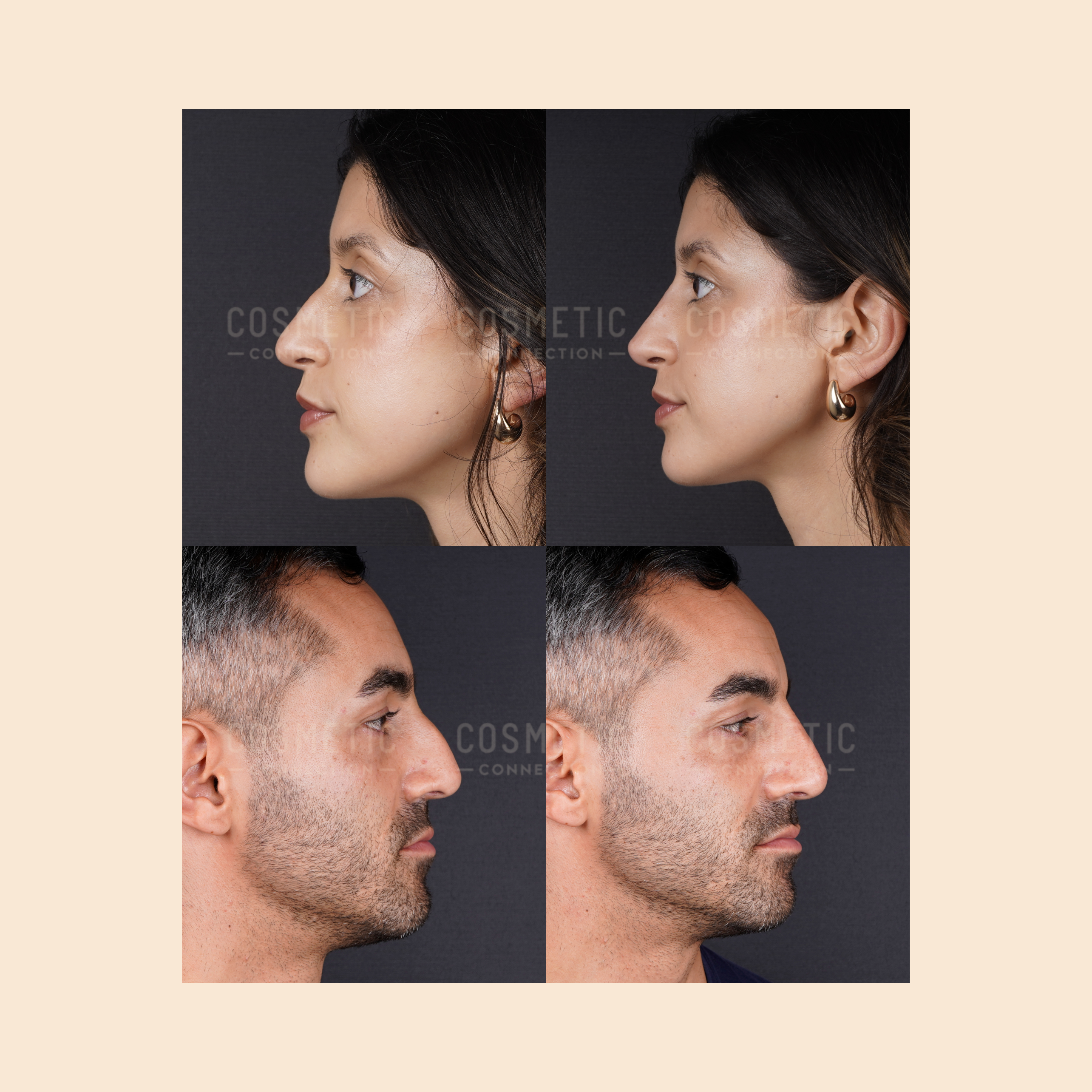 Side-by-side before and after profile photos of a woman (top row) and a man (bottom row), showing changes to their noses, likely following cosmetic procedures, against a plain background.