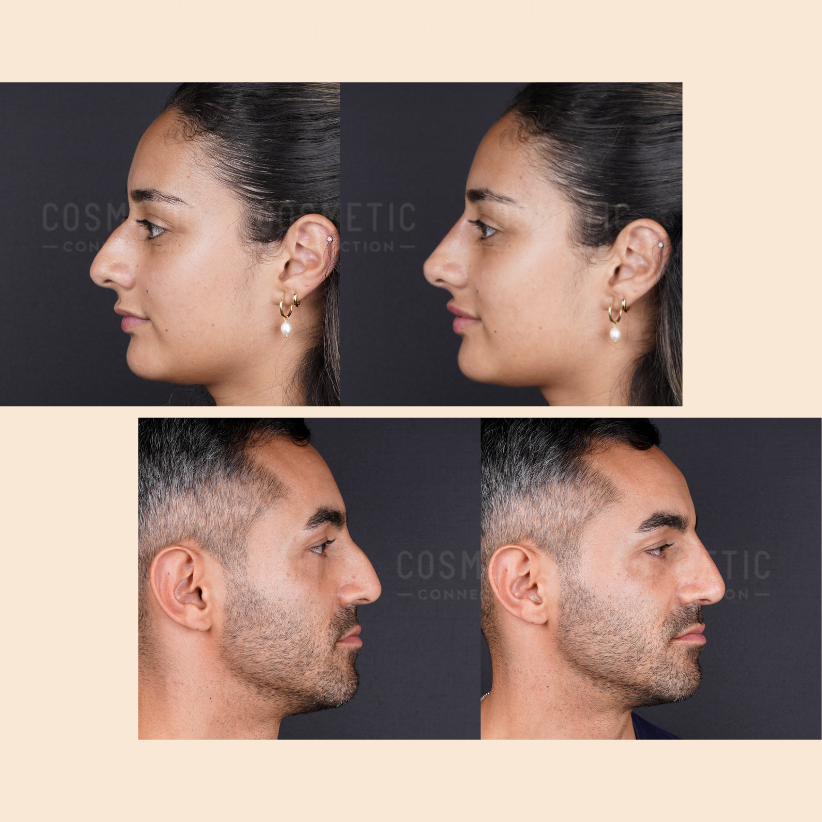 Four side-by-side before and after profile photos show a woman and a man with noticeable changes to their nose shapes, likely from cosmetic procedures. The background is neutral and both wear neutral expressions.