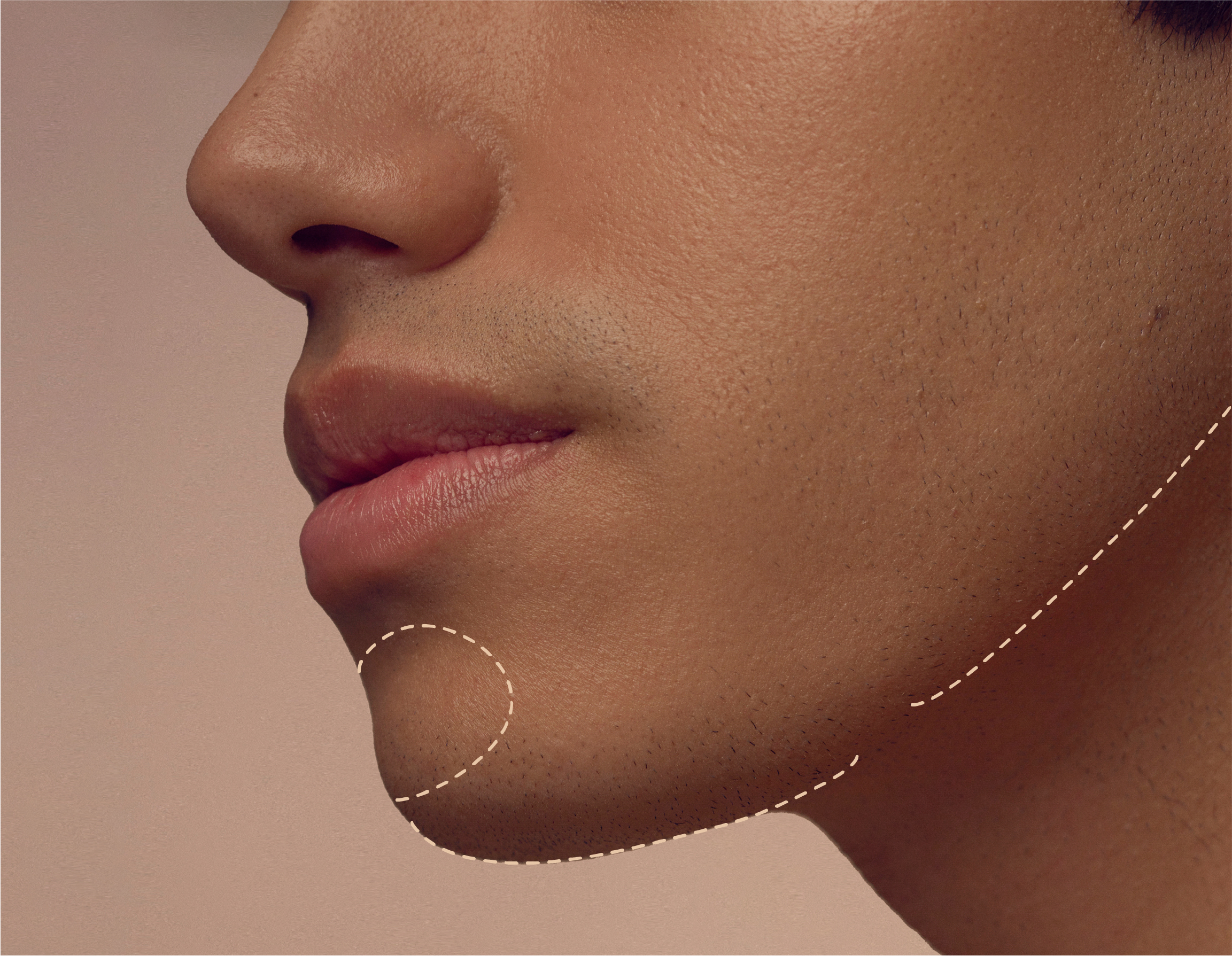 Close-up of a persons lower face and jaw, featuring a dotted line outlining the chin area. The skin appears smooth, and the background is a soft, neutral color.