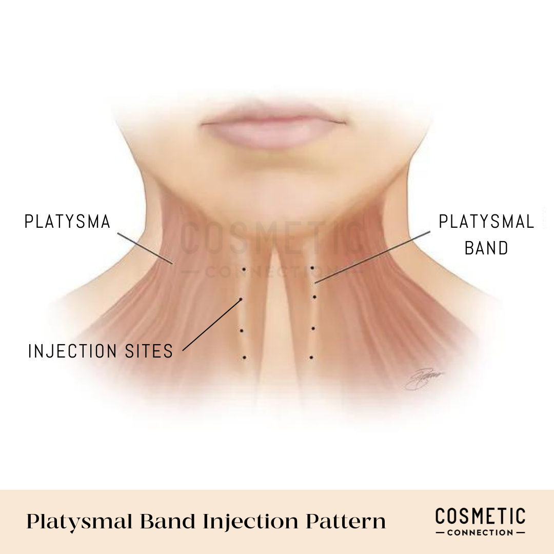 Medical illustration showing the platysmal band injection pattern on a human neck. Labeled Platysma, Platysmal Band, and Injection Sites with dots indicating where injections may be administered.