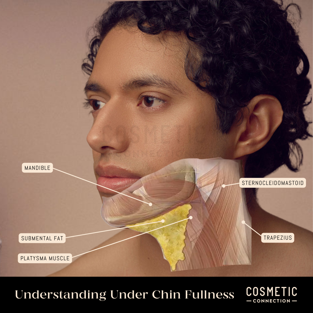 Chin Injections to Reduce Fat Beneath the Jawline