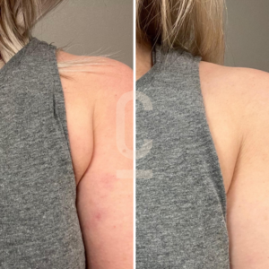 Split image comparison of a persons shoulder and upper arm wearing a grey sleeveless top. The left side shows noticeable skin blemishes, while the right side shows smoother skin, indicating a change after treatment or time.