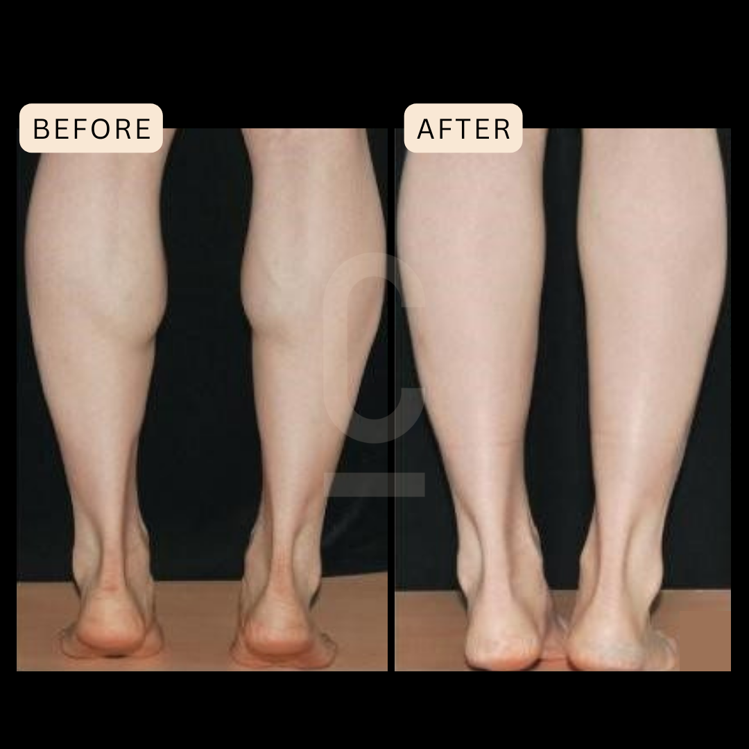 Calf Slimming injections, Best treatment to slim calves
