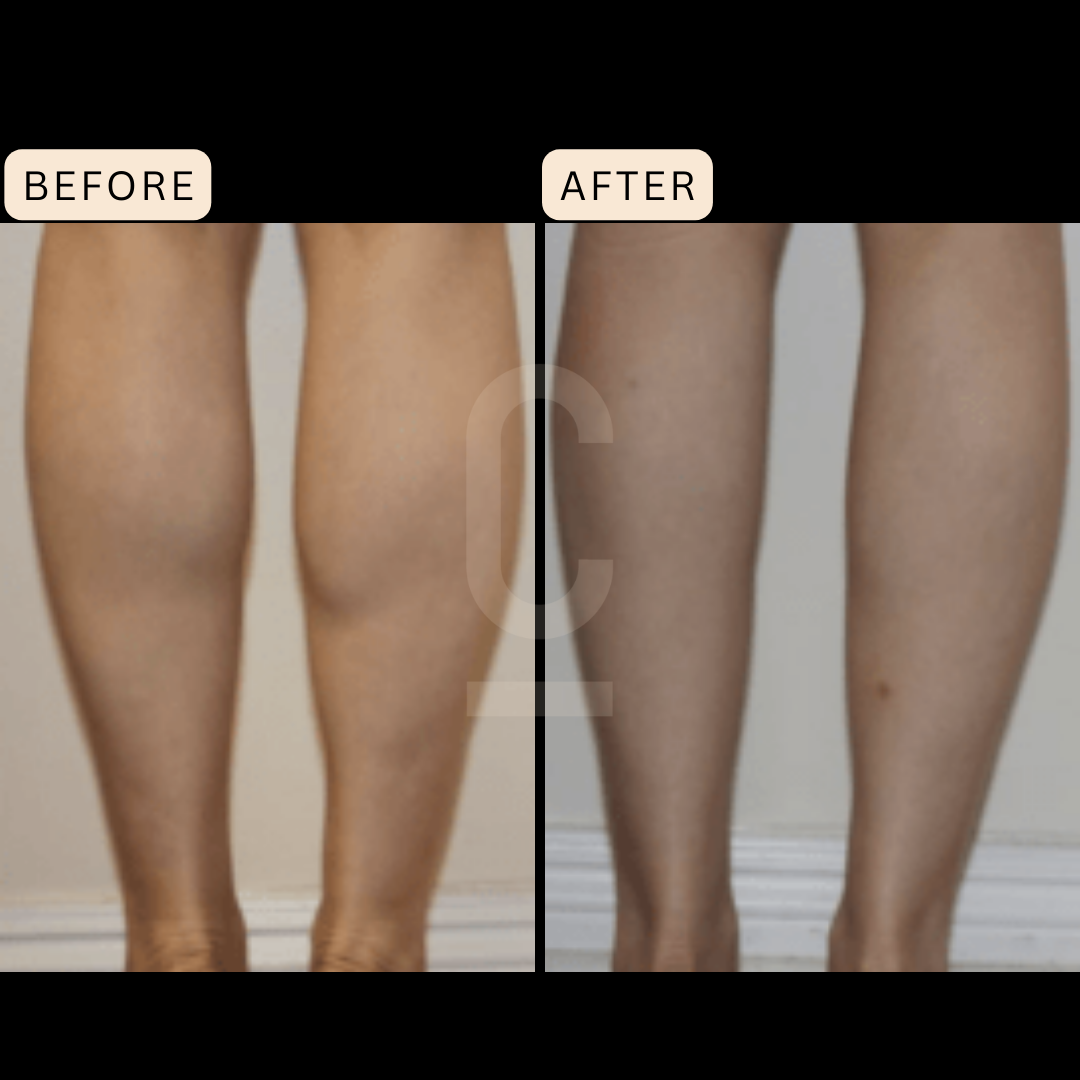 https://cosmeticconnection.com.au/wp-content/uploads/2022/11/Calf-Slimming-Injections-2.png