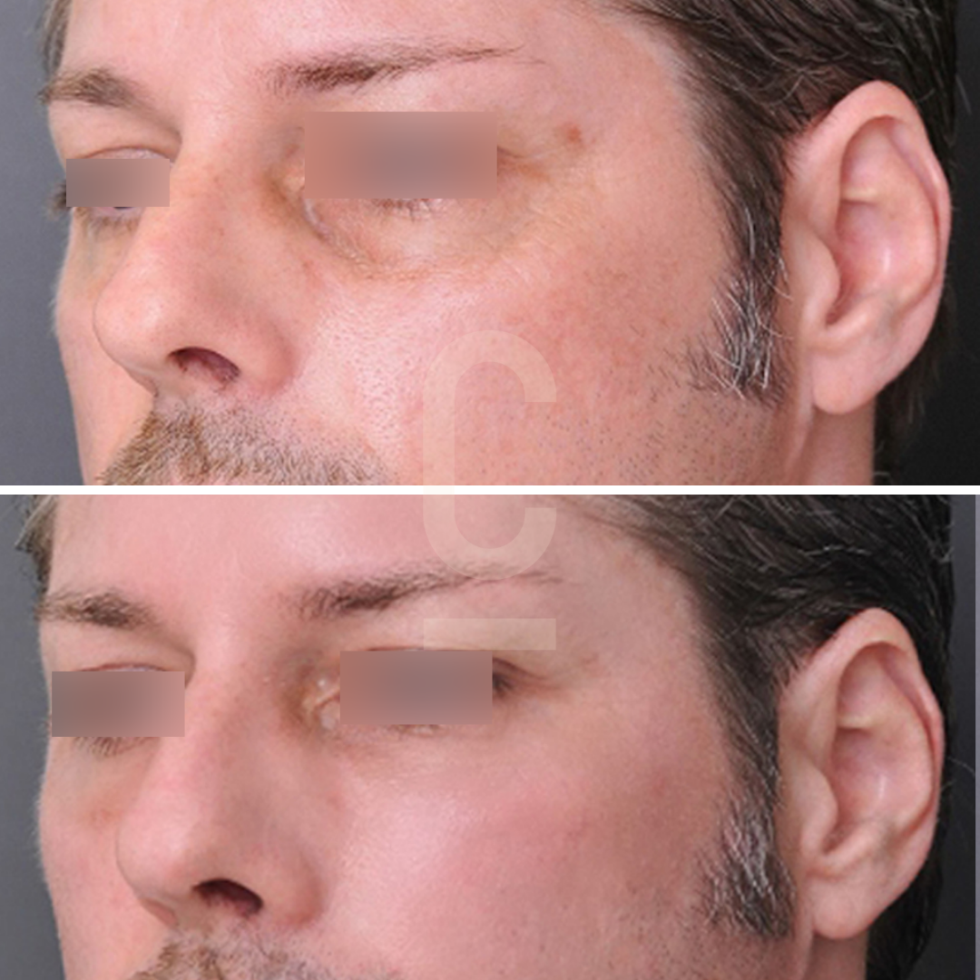 Side-by-side comparison of a mans face before and after an aesthetic treatment, showing reduced wrinkles and improved skin texture in the after image. Eyes are obscured for privacy.