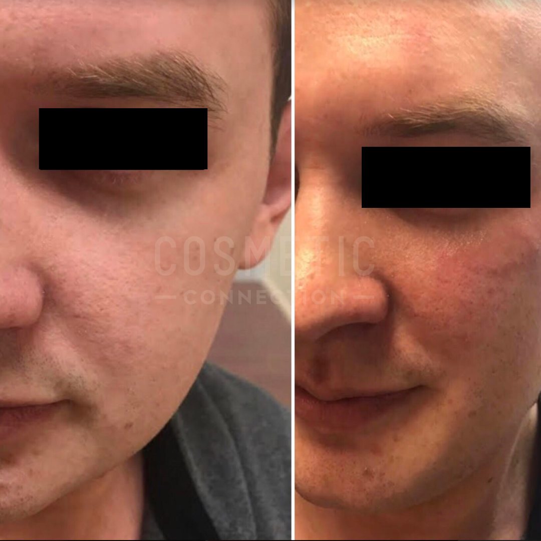 Side-by-side comparison of a persons face before and after a cosmetic procedure. The left image shows a smoother complexion, while the right shows redness and slight irregularities. Eyes are blacked out for privacy.