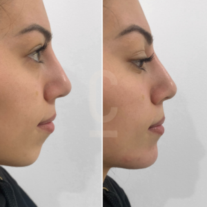 Side-by-side comparison of a persons profile, before and after a cosmetic procedure. The left image shows a more prominent nose and chin, while the right image displays a smoother, more balanced profile. Both images have a neutral background.