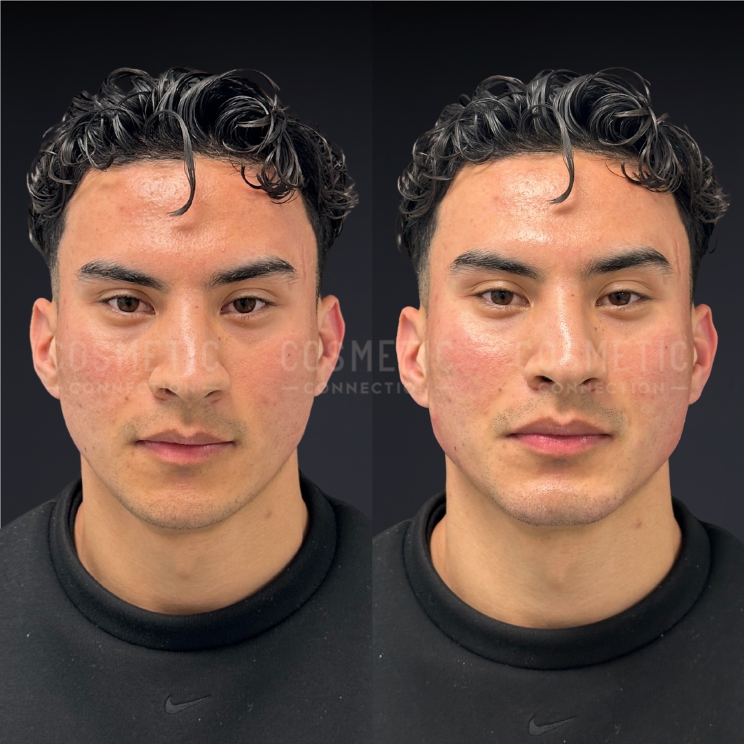 Side-by-side photos of a young man with short, curly dark hair and a black shirt, showing his face before (left) and after (right) a cosmetic skin treatment. The right side appears slightly redder and smoother.