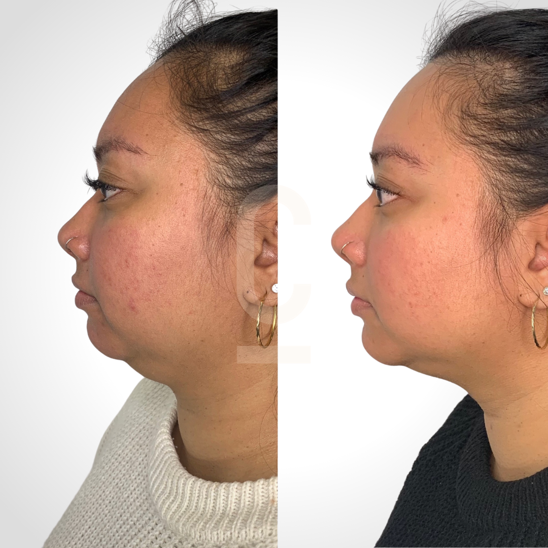 How To Get Rid Of A Double Chin Cosmetic Connection