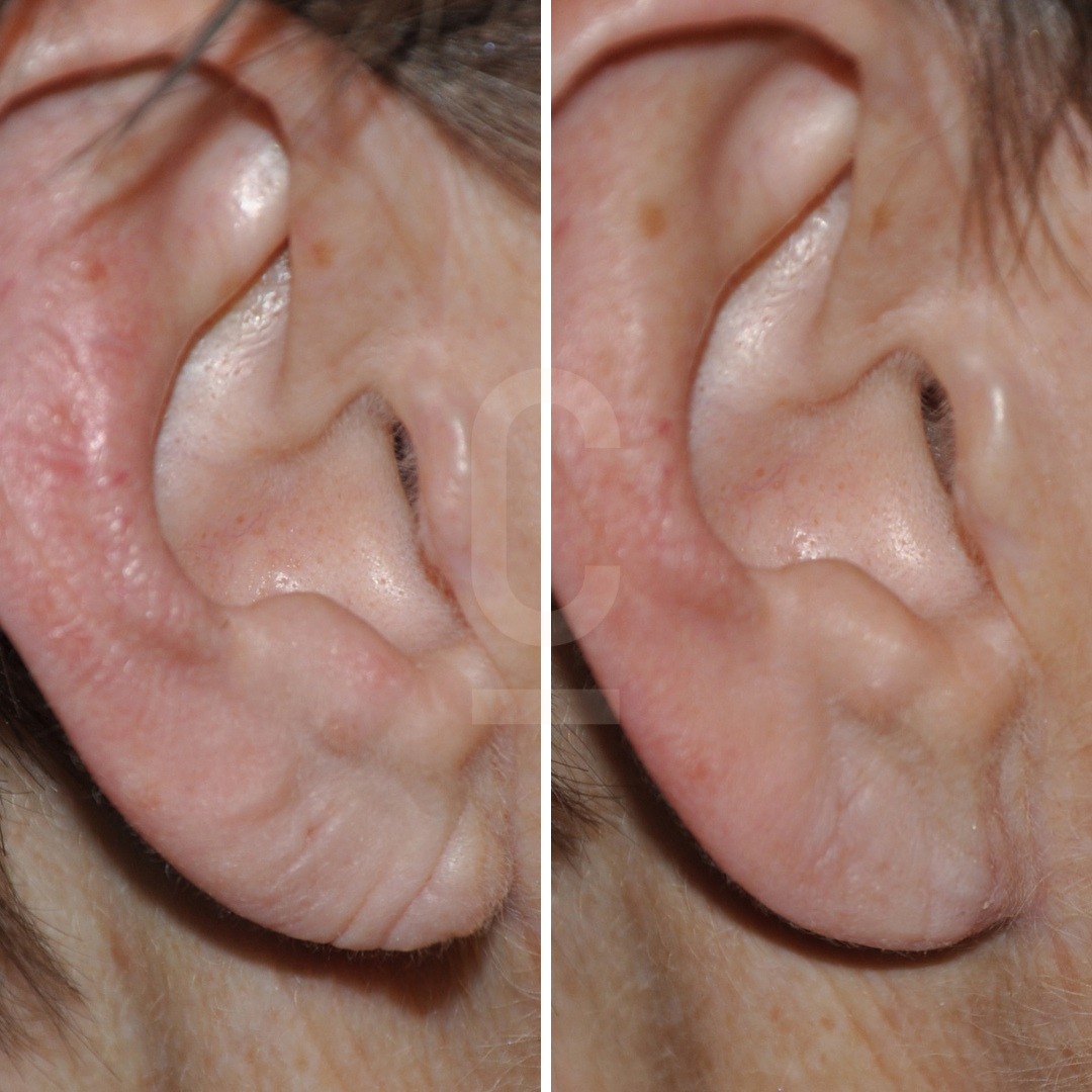 Earlobe Repair - The Complete Awesome Guide with Tips and