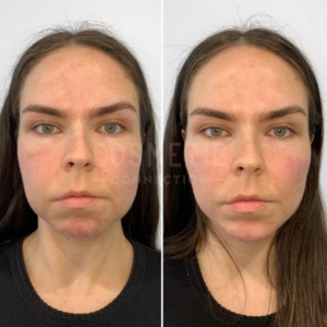 Side-by-side comparison of a womans face before and after dermal fillers, showing improved facial contours, definition, and proportions.