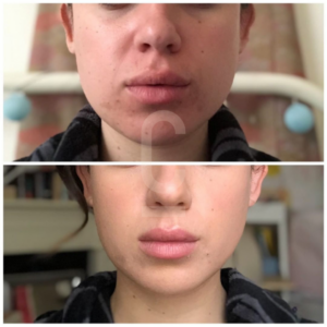 Two side-by-side close-up images of the lower face of a person. The first image shows a reddish, swollen area on the chin and lips, while the second appears to show a smoother, healed skin condition.