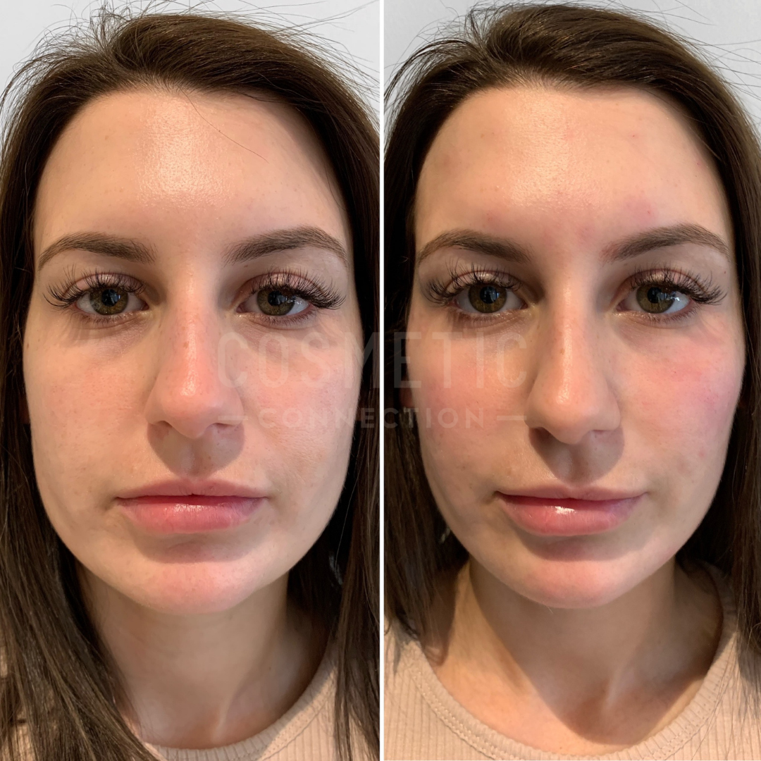 What Are My Options for Non-Surgical Facial Slimming and Contouring?