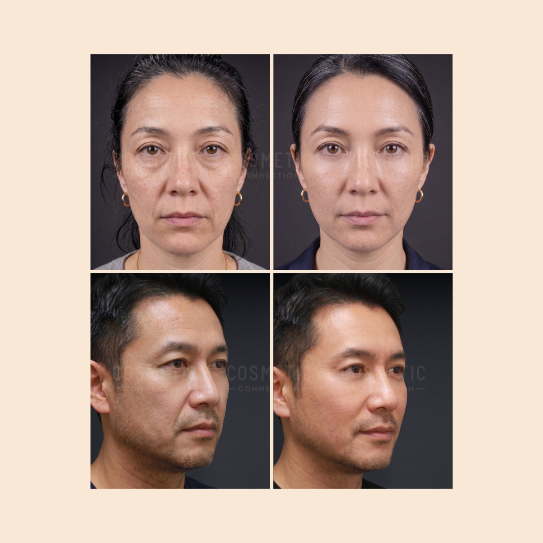 A before-and-after comparison of two individuals, one woman and one man, showing front and side views of their faces with visible improvements in skin texture and appearance.