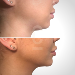 Side-by-side before and after profile images showing a persons jawline and neck. The top image shows a fuller neck under the chin, while the bottom image shows a more contoured and defined jawline. Both images are against a neutral background.