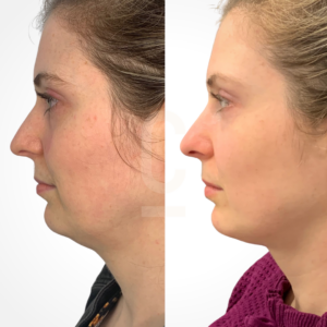 Side-by-side comparison of a womans profile before and after a cosmetic procedure. The left image shows her with a defined double chin, and the right image shows a more contoured jawline. Both images have her facing right.